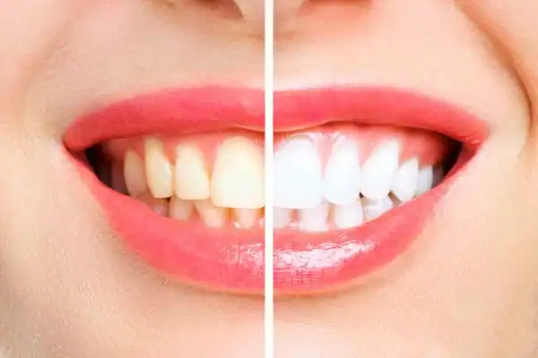 What Are the Common Myths About Laser Teeth Whitening Burgess Hill